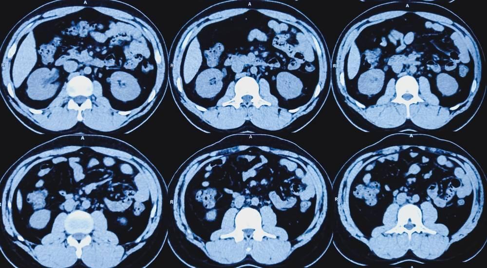 Best Scans to Detect Cancer - Envision Radiology